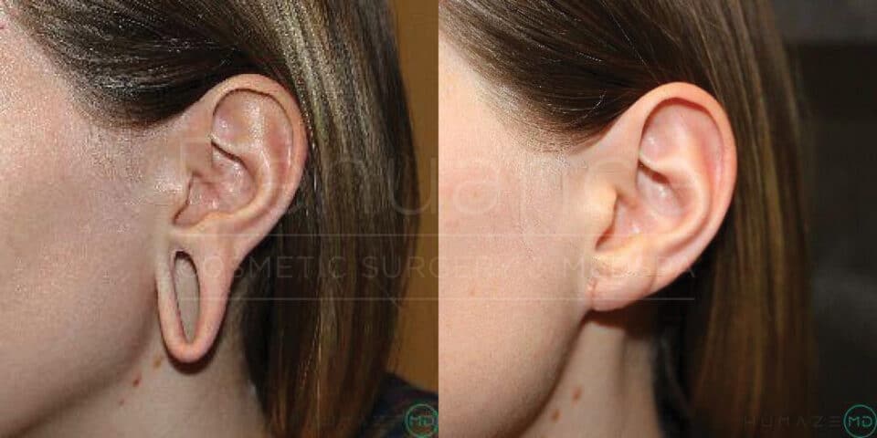 earlobe repair surgery with earlobe reduction before and after