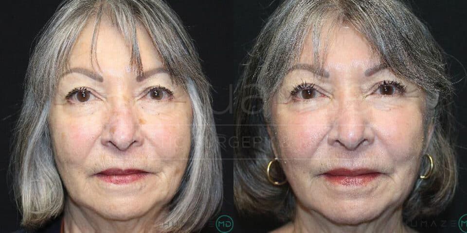 A side-by-side comparison of an elderly woman showing her face before and after a cosmetic procedure. The left image shows the woman before the procedure with less defined facial features, while the image on the right shows the woman after the procedure with visibly smoother and more youthful skin. Both images depict the woman with short gray hair and similar facial expressions.
