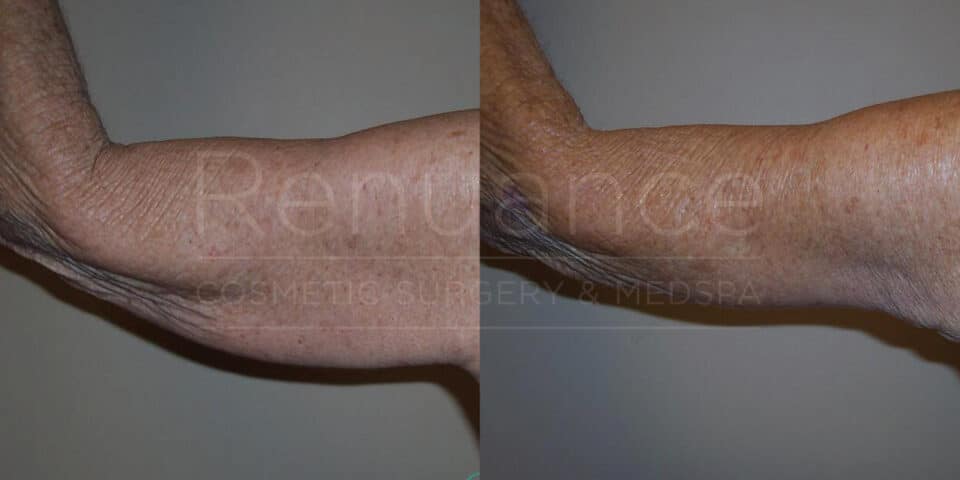 Comparison of the back of a person's upper arm before and after a cosmetic procedure. The left side shows the arm with loose, sagging skin, while the right side shows the arm with significantly less sagging and tighter skin. The image appears to be from a cosmetic surgery or medspa clinic.