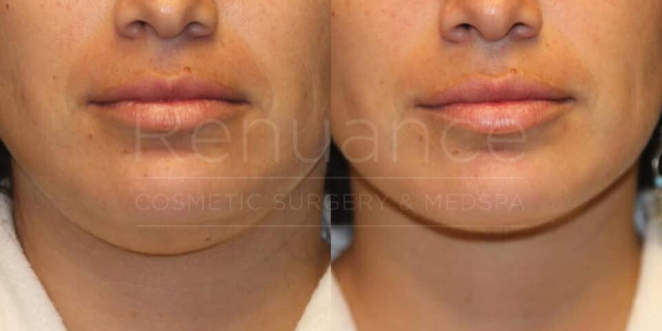 A before-and-after comparison image of a person's lower face. The left side shows the face prior to treatment, with marked pigmentation and some blemishes around the cheeks and lips. The right side shows the face after treatment, revealing smoother and more even skin tone, with a reduction in pigmentation and blemishes. The text "Renuance Cosmetic Surgery & Medspa" is faintly visible across the middle of the image.