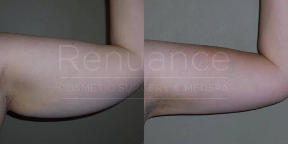 A comparison image featuring a close-up of two upper arms. The left side displays an arm with more fat and sagging skin, while the right side shows the same arm after a cosmetic procedure, appearing slimmer and more toned. The overlay text reads "Renuance Cosmetic Surgery & Medspa."