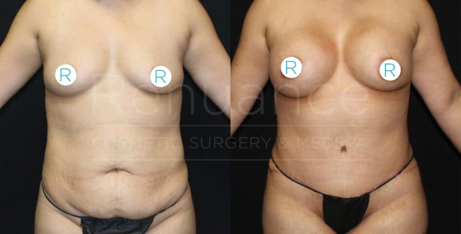 A before and after image showing the results of cosmetic surgery on a person's torso. The left side of the image shows the person's body before surgery, while the right side shows the body post-surgery with noticeable changes in contour and appearance. The person is standing upright with their arms slightly out to their sides in both images, and their chest is covered with circular markers labeled "R". The background is plain and dark.