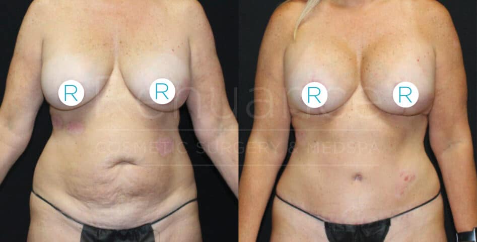 "Side-by-side comparison of a woman's torso showing before and after results of cosmetic surgery. The left image displays the body before surgery, with visible signs of sagging skin and lack of contour. The right image shows the body after surgery, with a more defined and toned appearance. Both images have 'R' stickers covering the breast area for modesty."