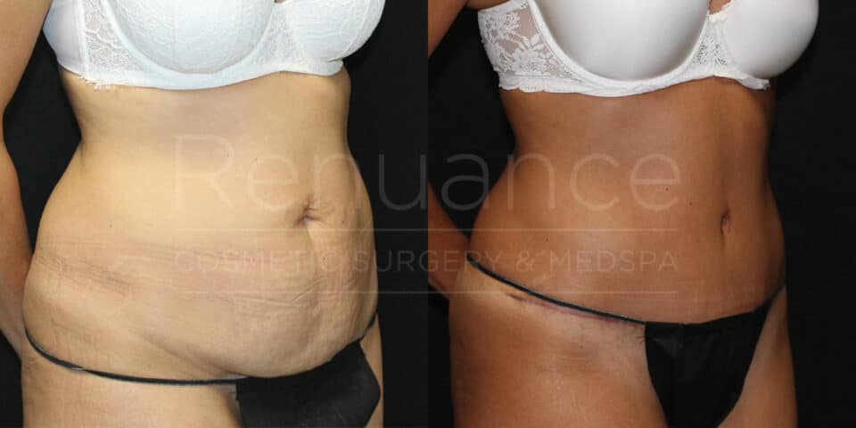 a female patient from murrieta before and after a tummy tuck