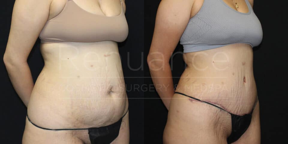 Tummy tuck transformation before and after - serving Murrieta patients