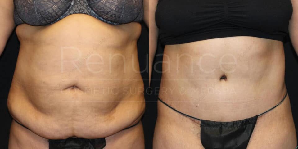 Tummy tuck before and after results from our Temecula practice
