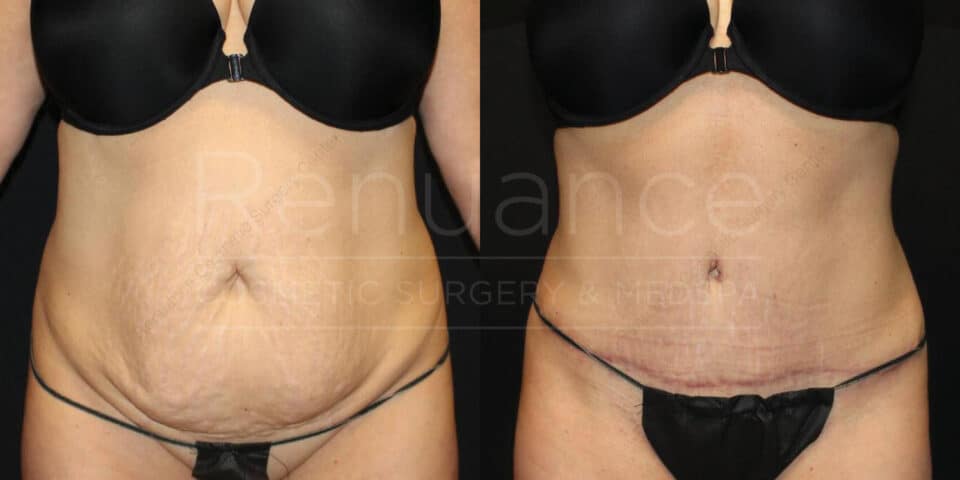 Before and after tummy tuck showing abdomen restoration