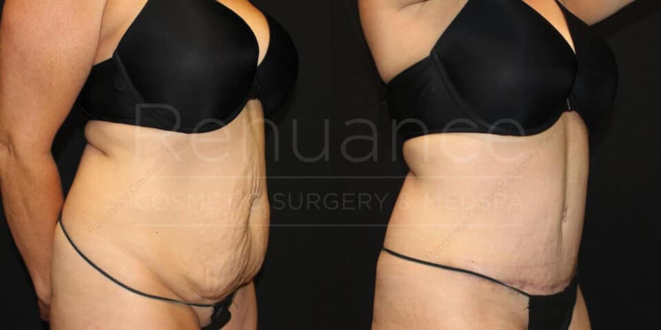 Tummy tuck before and after results - Temecula and Murrieta area