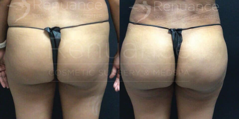 Side-by-side comparison of two images showing the back view of a person wearing a black thong. The image on the left shows the person before surgery, and the image on the right shows the person after a cosmetic surgery procedure, highlighting changes in the buttocks shape and contour. The text overlay reads "Renuance Cosmetic Surgery Center" and "Renuance Cosmetic Surgery & MedSpa."
