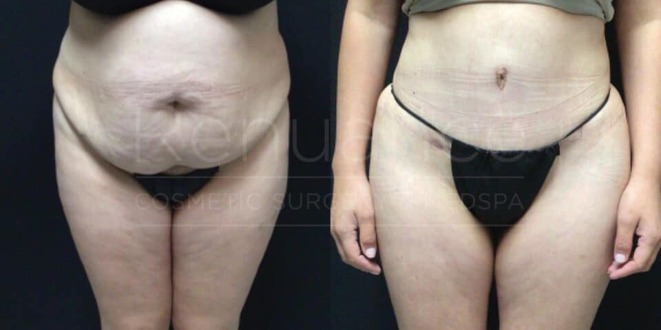 A side-by-side comparison shows the before and after results of abdominal cosmetic surgery. The left image illustrates the person's abdomen and thighs with excess skin and fat, while the right image shows the same area after the procedure, with a smoother and more contoured appearance.