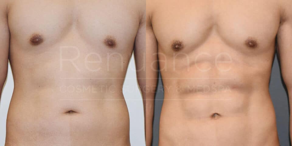 The image shows a comparison of a person's torso before and after a cosmetic procedure. The left side depicts the torso before the procedure, with a softer and fuller appearance. The right side shows the torso after the procedure, with a more toned and defined look. The background has the text "Renaissance Cosmetic Surgery & Medspa" overlaid across the image.