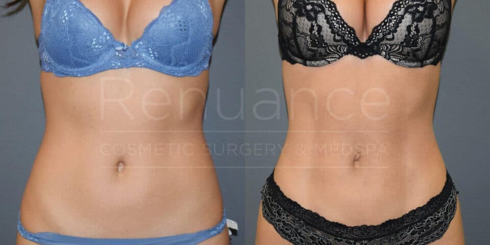 A side-by-side comparison of a woman's torso before and after an unspecified cosmetic procedure. The left image shows a woman wearing a blue bra and matching underwear, while the right image shows the same woman in a black lace bra and matching underwear. Both images focus on the woman's midsection, highlighting changes in appearance. The background is a neutral grey, and the words "Renuance Cosmetic Surgery & Med Spa" are faintly visible on both images.