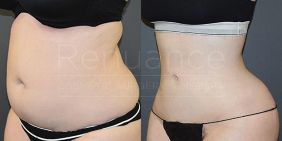 A side-by-side comparison of two images illustrating the before and after results of a cosmetic procedure. The first image on the left shows a person with a slightly larger abdomen and more pronounced body contours. The second image on the right displays the same person with a noticeably flatter abdomen and smoother body contours, indicating the changes post-procedure. Both images are taken from the same angle, emphasizing the transformation. The person is wearing similar black undergarments in both images.
