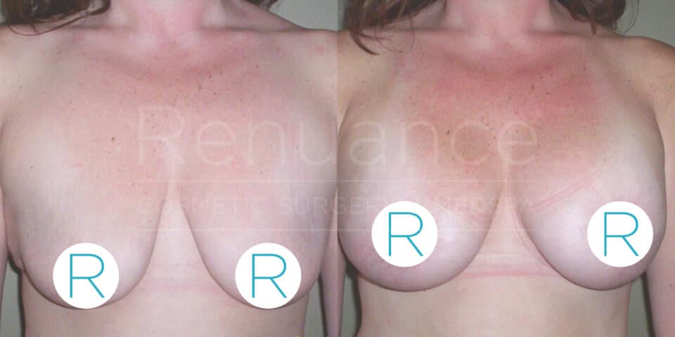 A side-by-side comparison of a woman’s chest, showing before and after images of breast augmentation surgery. The left image shows natural breasts, while the right image shows enhanced or lifted breasts with surgical markings visible. The background appears neutral, and each breast is labeled with the letter "R."
