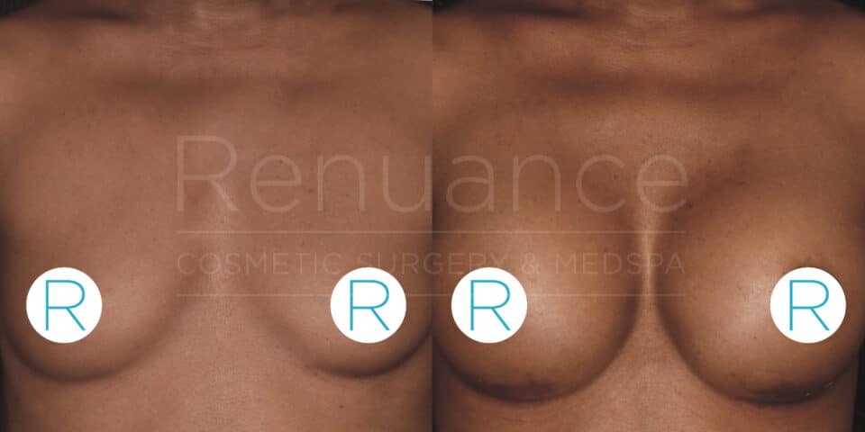 Side-by-side comparison of a person's chest before and after cosmetic breast enhancement surgery. The image on the left shows the "before" state, while the image on the right shows the "after" state with increased breast size. Each photo has a circular label with the letter "R" on the lower part of each breast. The background text says "Renuance COSMETIC SURGERY & MEDSPA."