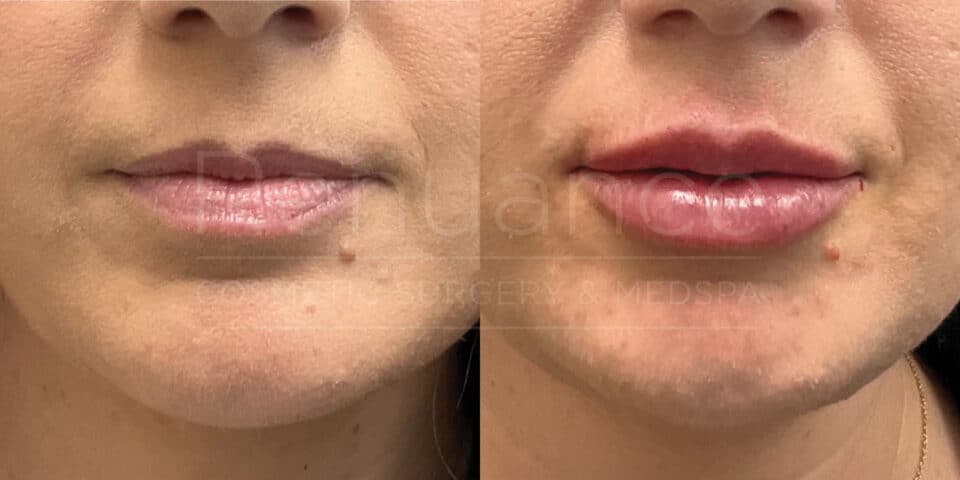 lip fillers before and after the procedure