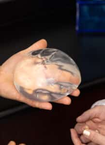 A person is holding a clear, round breast implant in their hand, while another person is reaching towards it.