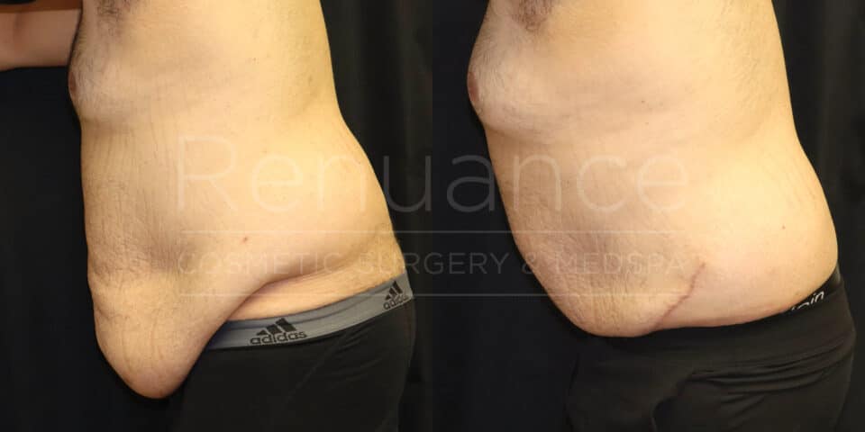 Before and after excess skin removal with liposuction - patient from Murrieta