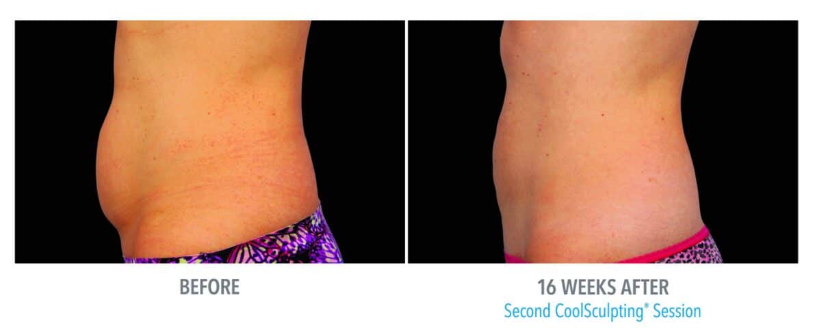 CoolSculpting-01-renuance