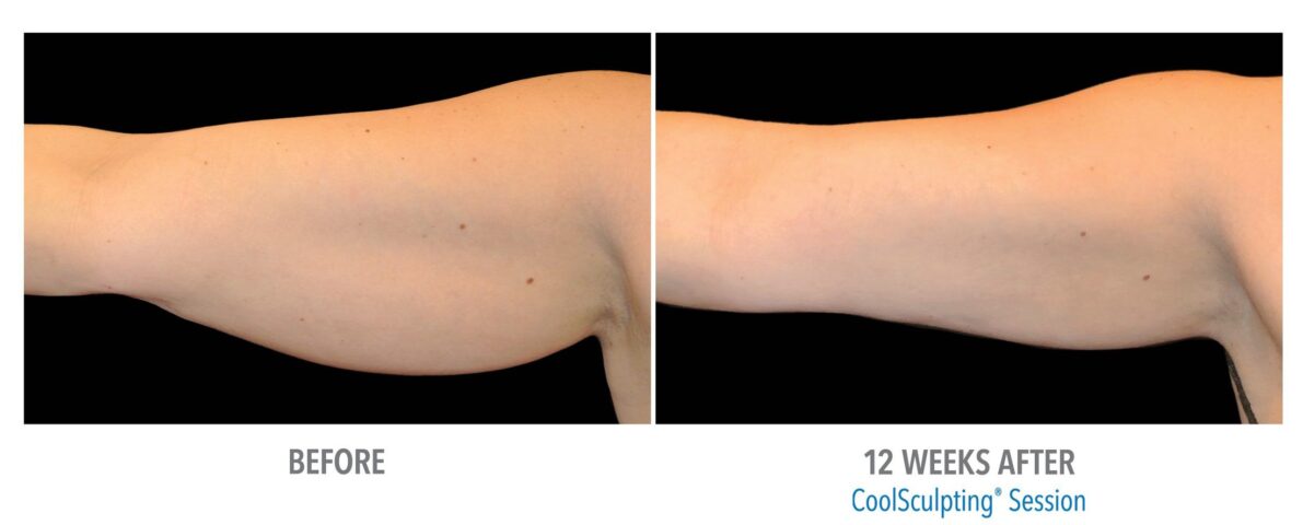 CoolSculpting-04-renuance