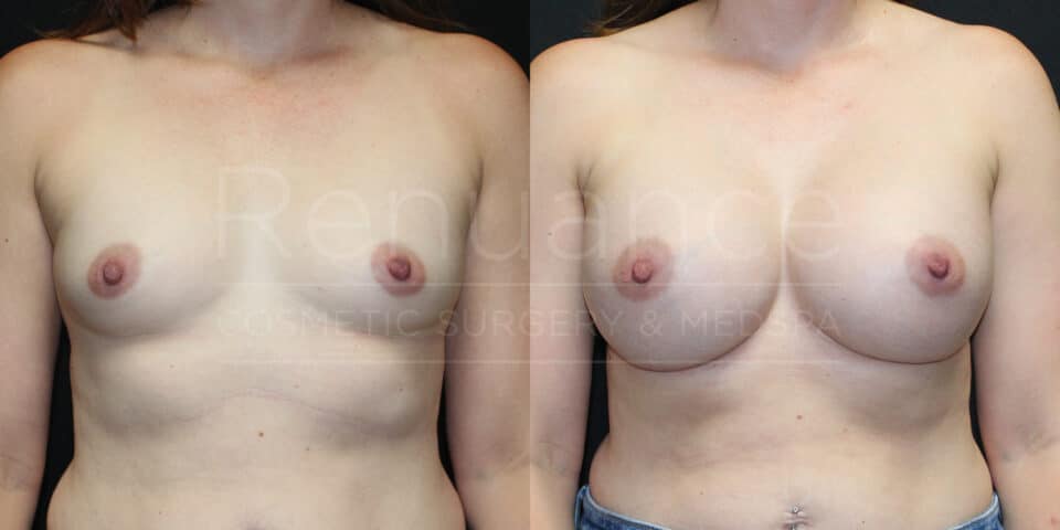 Breast Augmentation Before and After photos performed by Dr. Rachel S. Ford