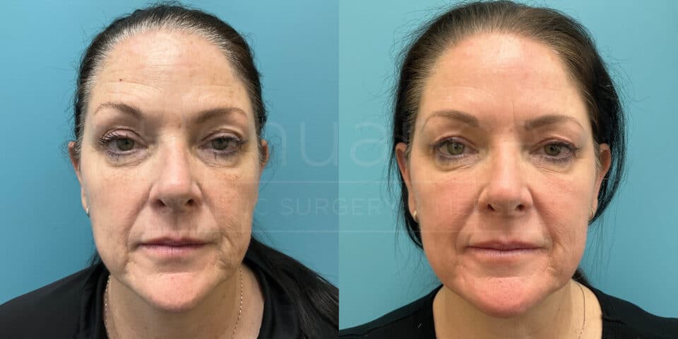 CO2 Laser Resurfacing
