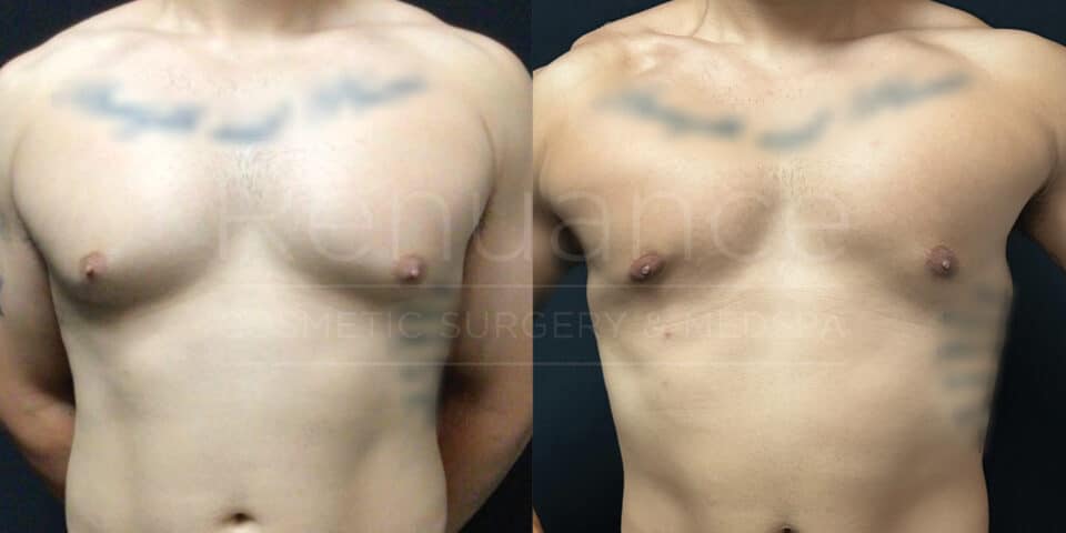 Renuance-Before&After-dr-Hill-Vaser-Liposuction-and-excision-of-bilateral-gynecomastia-under-local-with-oral-sedation-and-ProNox-11-06-2024