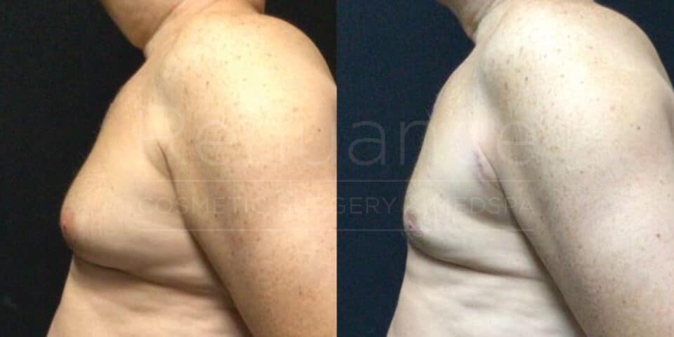 Renuance-Before&After-dr-Hill-Vaser-Liposuction-with-excision-for-gynecomastia- (2)