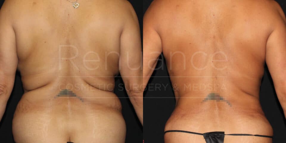 renuance ford female back liposuction