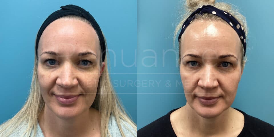 A woman before and after the Elos IPL Photofacial + RF Laser treatment at Renuance with Dr Debbie