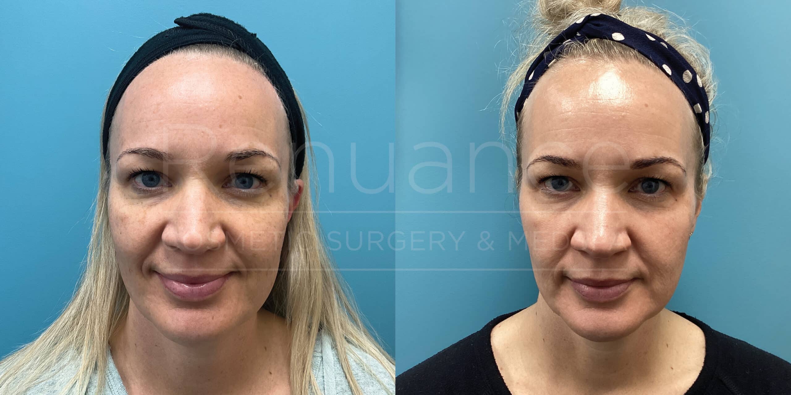 Renuance Dr Debbie SRA IPL