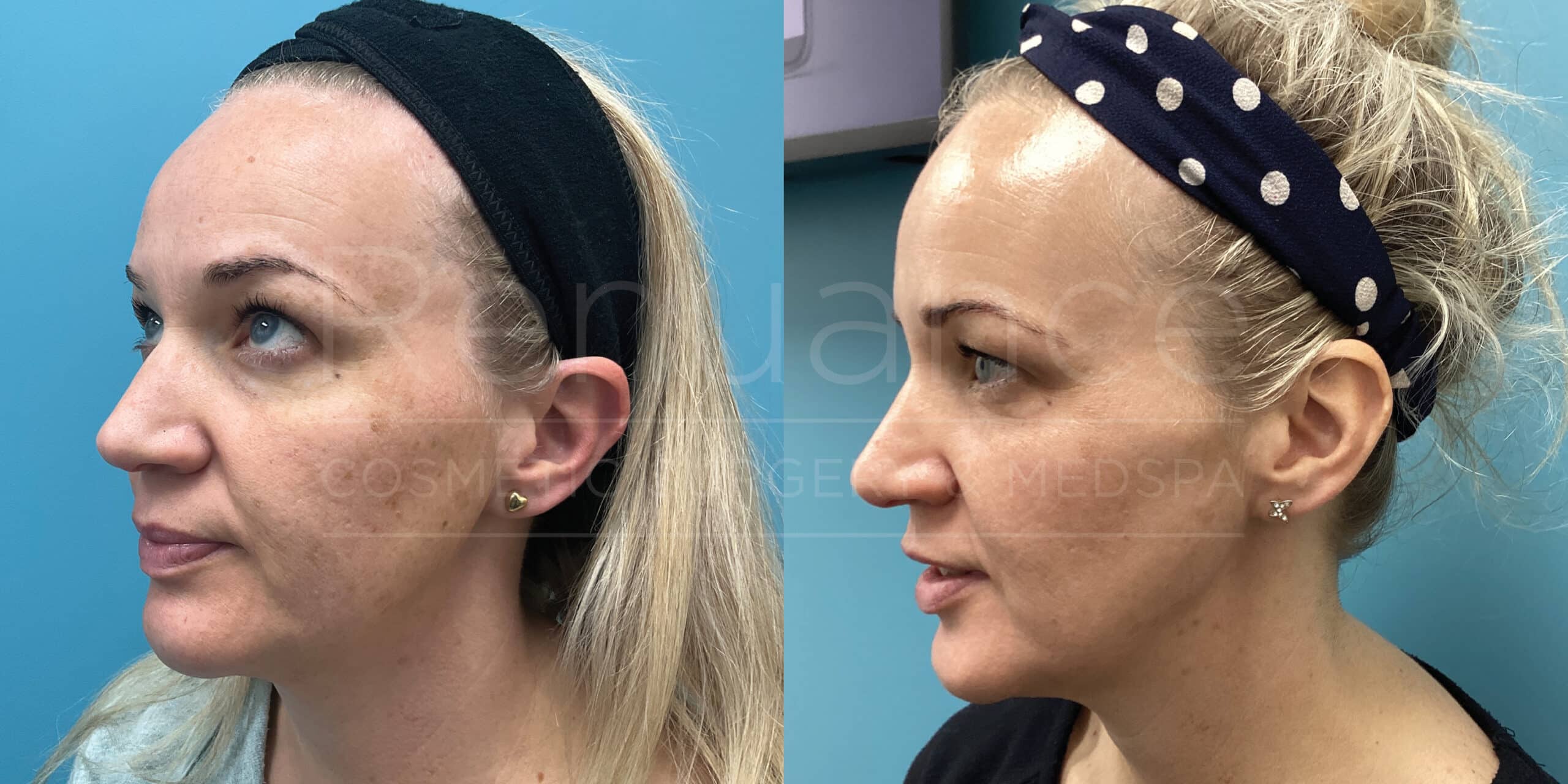 Renuance Dr Debbie SRA IPL