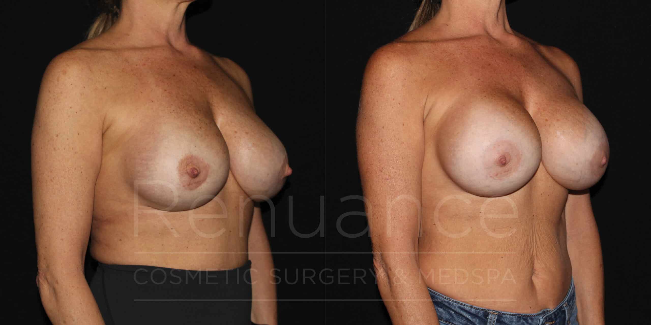 Breast Augmentation Before and After Photos