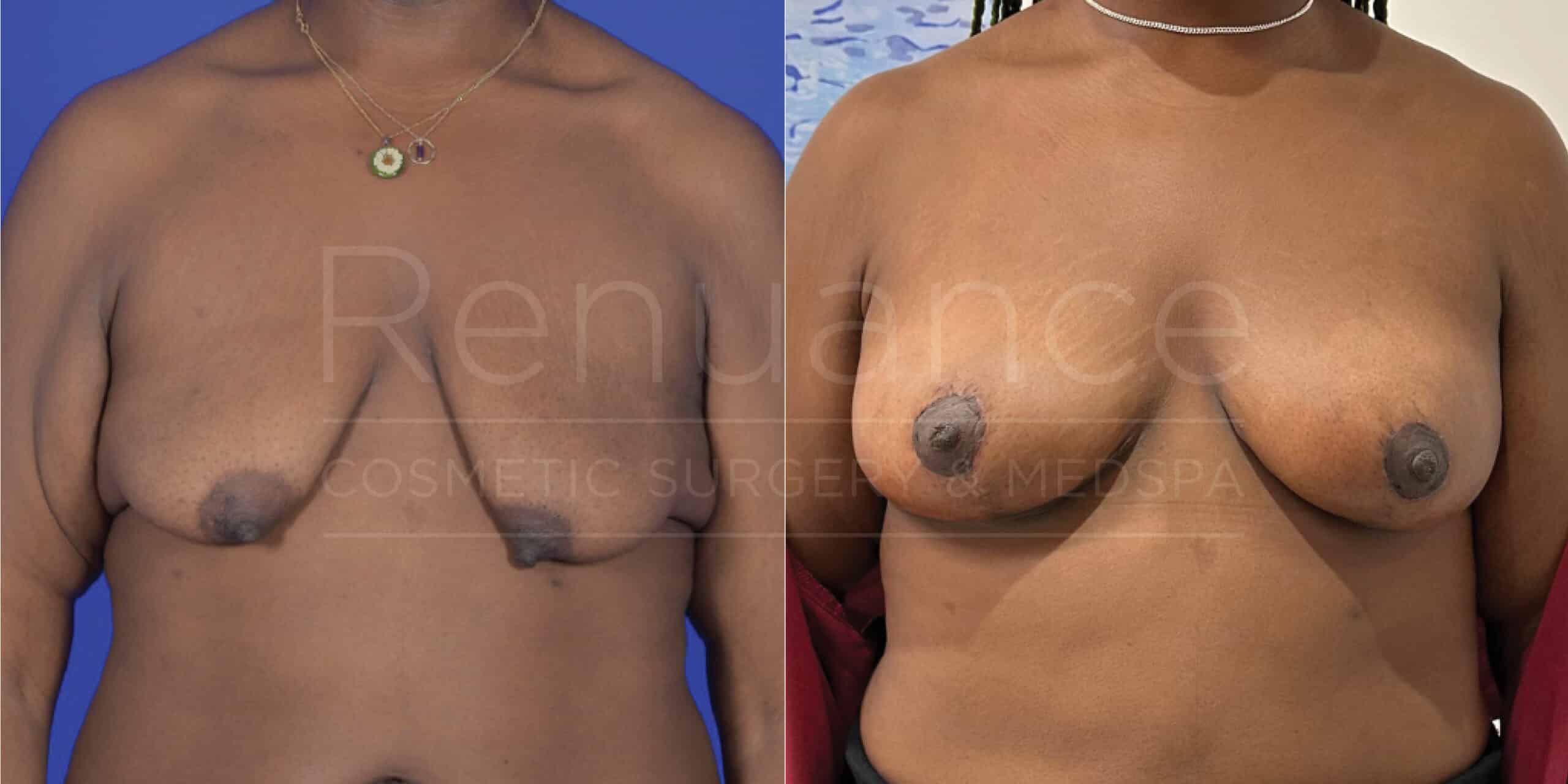 Renuance Dr Cohen breast augmentation