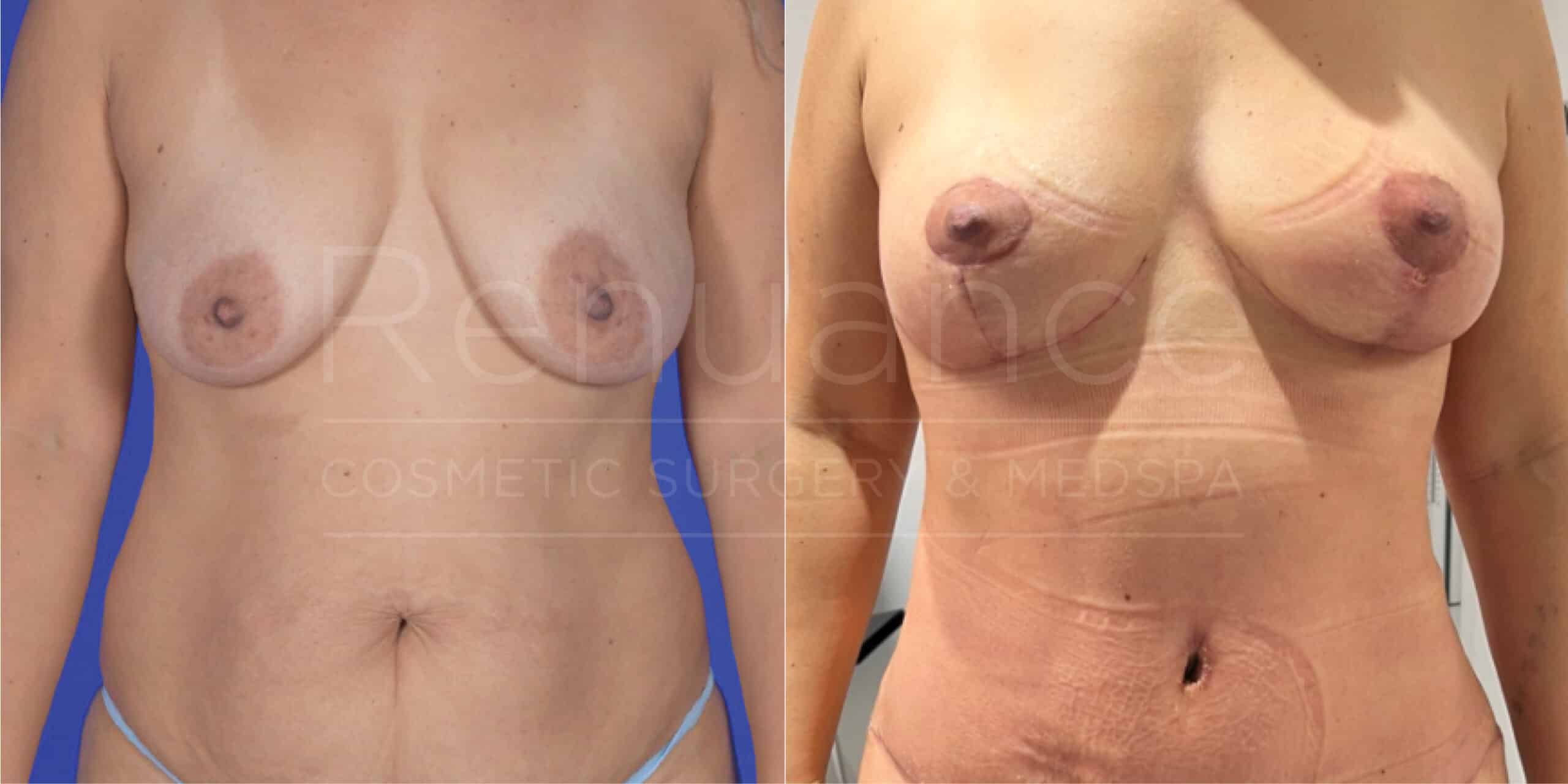 Renuance Dr Cohen mommy makeover no implants