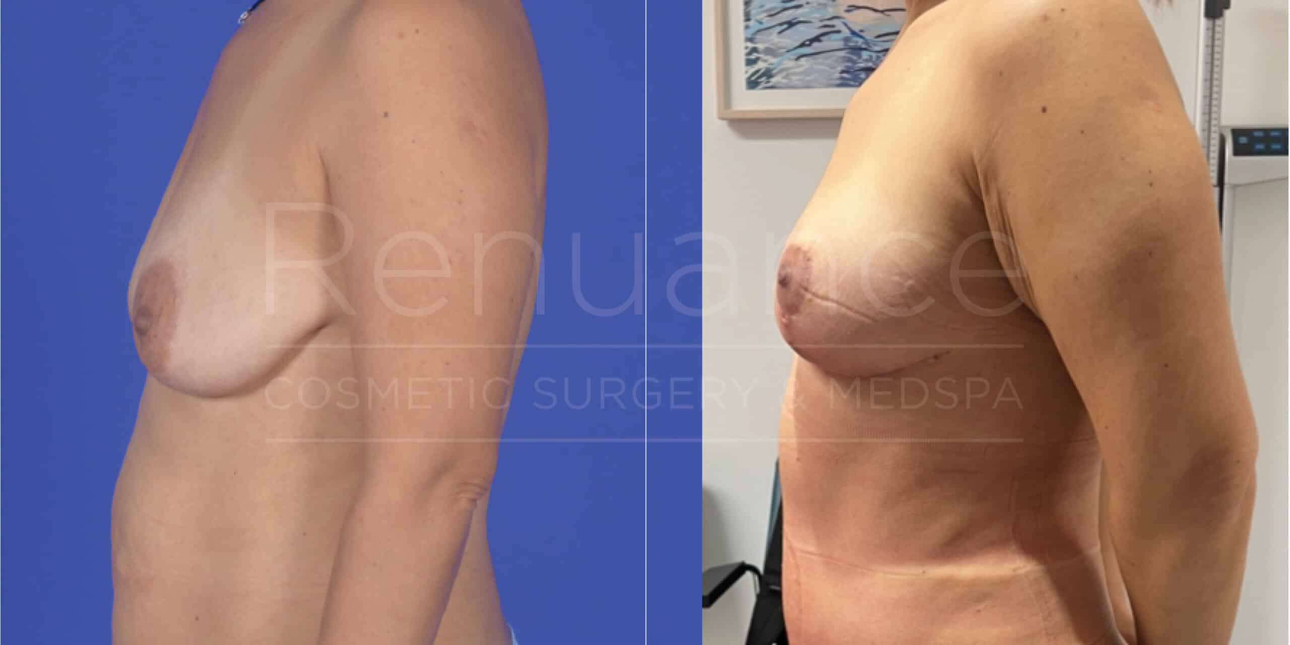 Renuance Dr Cohen mommy makeover no implants