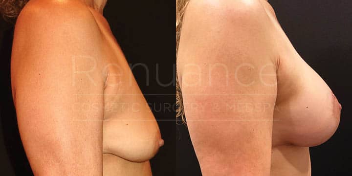 Renuance - breast augmentation by Jose Rodriguez, MD