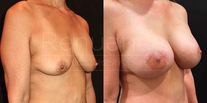Renuance - breast augmentation by Jose Rodriguez, MD