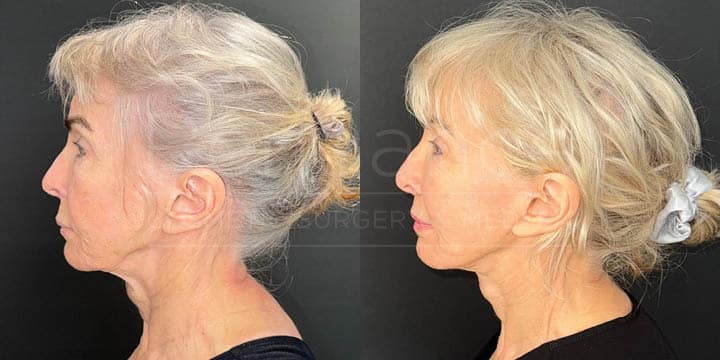 Renuance - face lift, facial fat transfer, and neck lift by Jose Rodriguez, MD