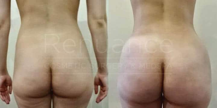Renuance - body contouring, liposuction, and bbl by Jose Rodriguez, MD
