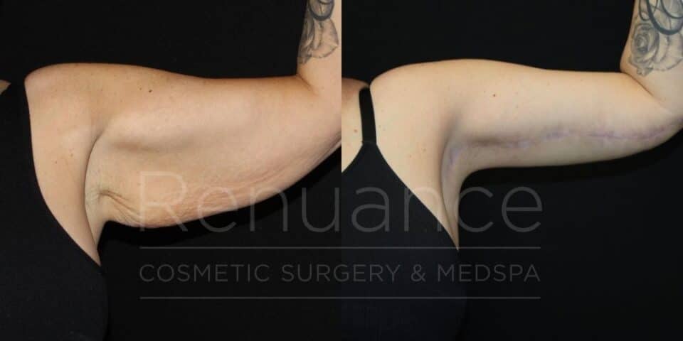 Renuance Dr Ford Brachioplasty