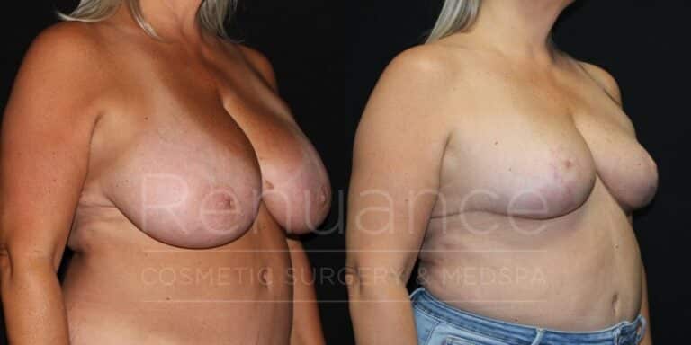 Renuance Dr Ford breast reduction