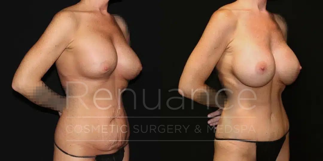 Renuance Dr Ford Mommy Makeover