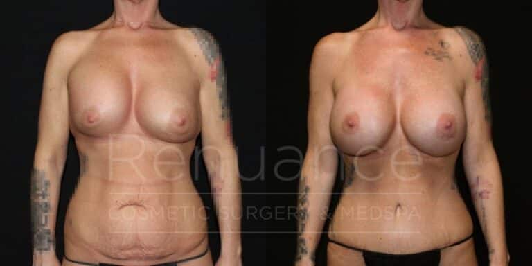 Renuance Dr Ford Mommy Makeover