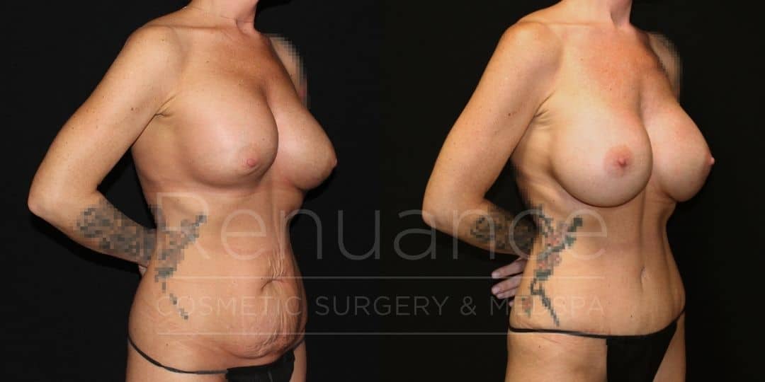 Renuance Dr Ford Mommy Makeover