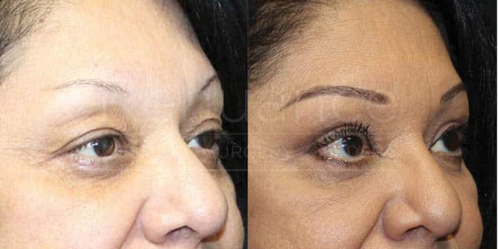 A side-by-side comparison of a woman's face before and after a cosmetic procedure. The left image shows the woman's face, where she has more pronounced wrinkles, sagging skin, and a tired appearance. In the right image, her face appears rejuvenated, with smoother skin, fewer wrinkles, and a more refreshed look. She has applied makeup, including foundation, eyeshadow, and eyeliner.