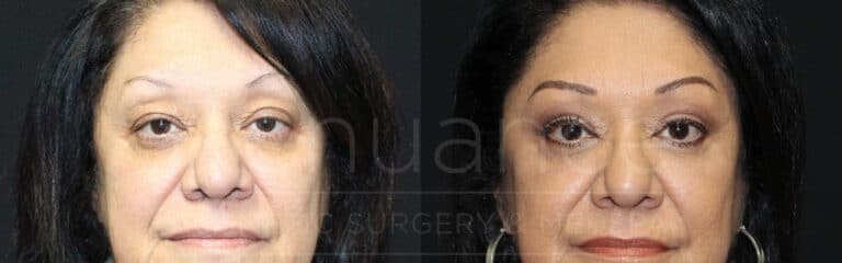A side-by-side comparison of a woman's face before and after a cosmetic procedure. The left image shows the woman's face, where she has more pronounced wrinkles, sagging skin, and a tired appearance. In the right image, her face appears rejuvenated, with smoother skin, fewer wrinkles, and a more refreshed look. She has applied makeup, including foundation, eyeshadow, and eyeliner.