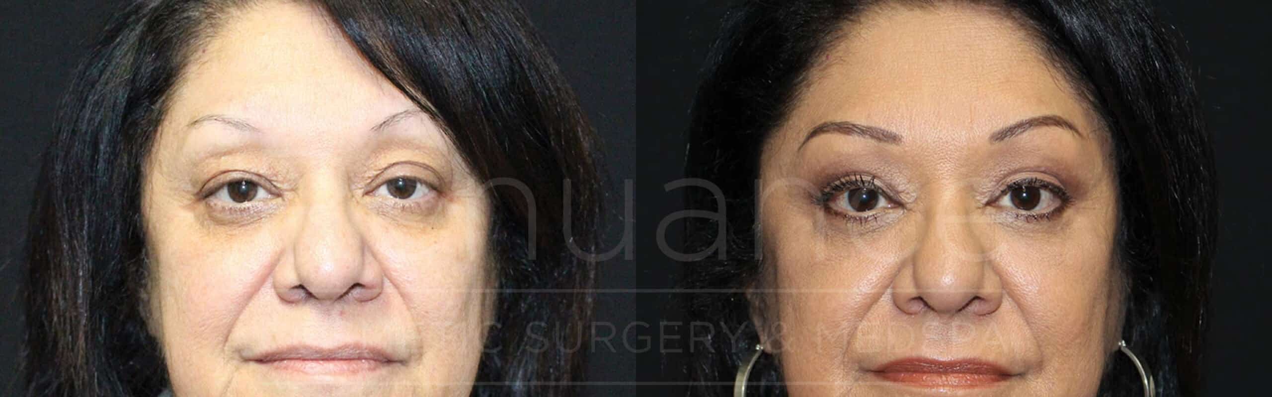 A side-by-side comparison of a woman's face before and after a cosmetic procedure. The left image shows the woman's face, where she has more pronounced wrinkles, sagging skin, and a tired appearance. In the right image, her face appears rejuvenated, with smoother skin, fewer wrinkles, and a more refreshed look. She has applied makeup, including foundation, eyeshadow, and eyeliner.