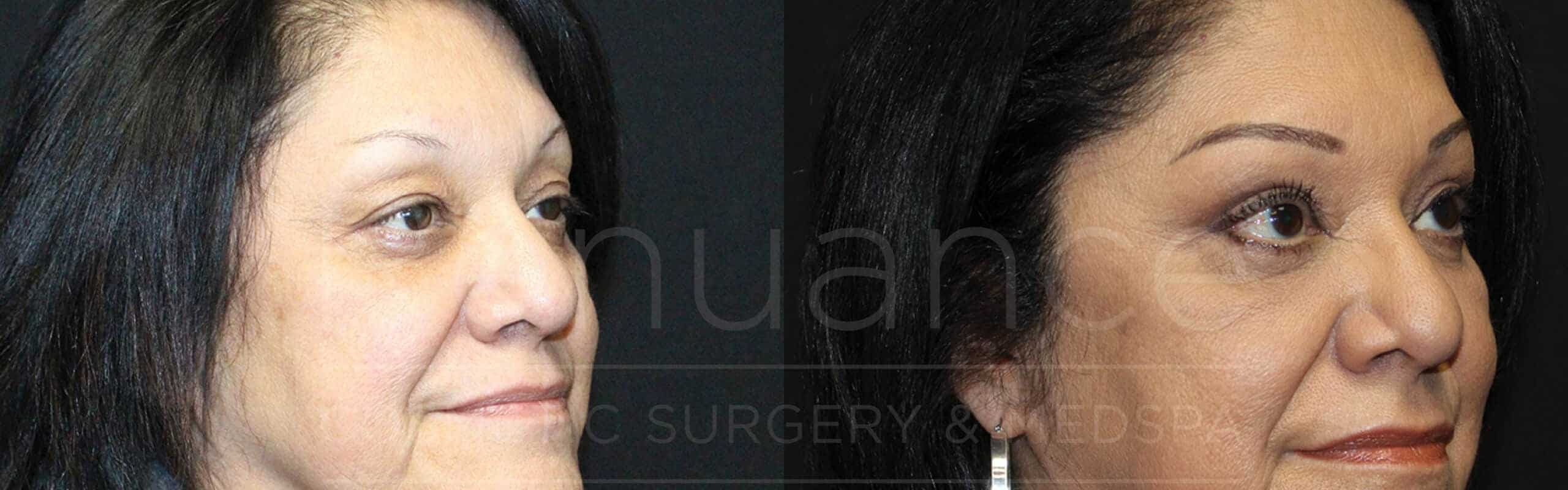 A side-by-side comparison of a woman's face before and after a cosmetic procedure. The left image shows the woman's face, where she has more pronounced wrinkles, sagging skin, and a tired appearance. In the right image, her face appears rejuvenated, with smoother skin, fewer wrinkles, and a more refreshed look. She has applied makeup, including foundation, eyeshadow, and eyeliner.
