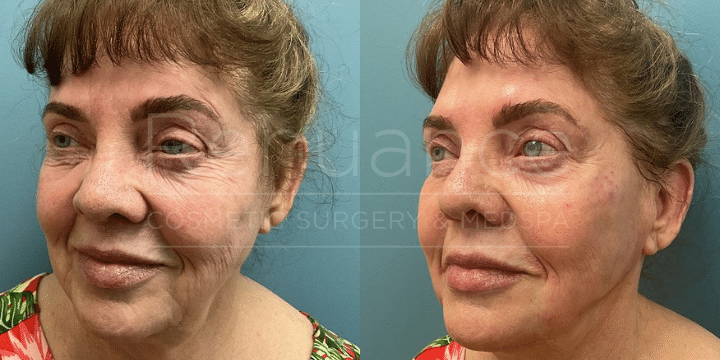 Cheek Filler
